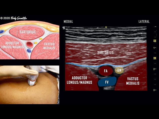 Adductor Canal Block (Saphenous Nerve) // Ultrasound-Guided Demonstration class=