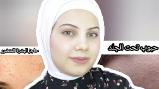 أفضل روتين لعلاج حاجز البشرة المتضرر والحبوب تحت الجلد والفرق بينهم | احمرار | التهاب | حبوب