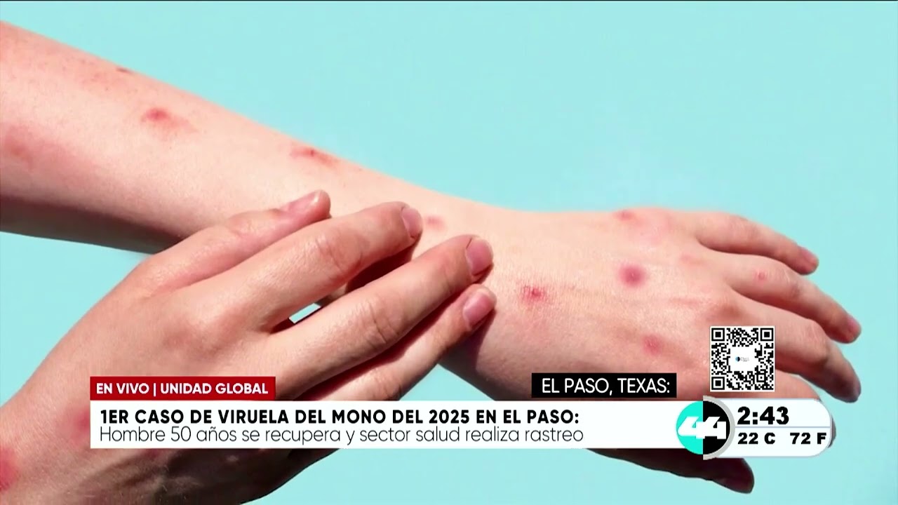 1ercaso de viruela del mono del 2025 en El Paso