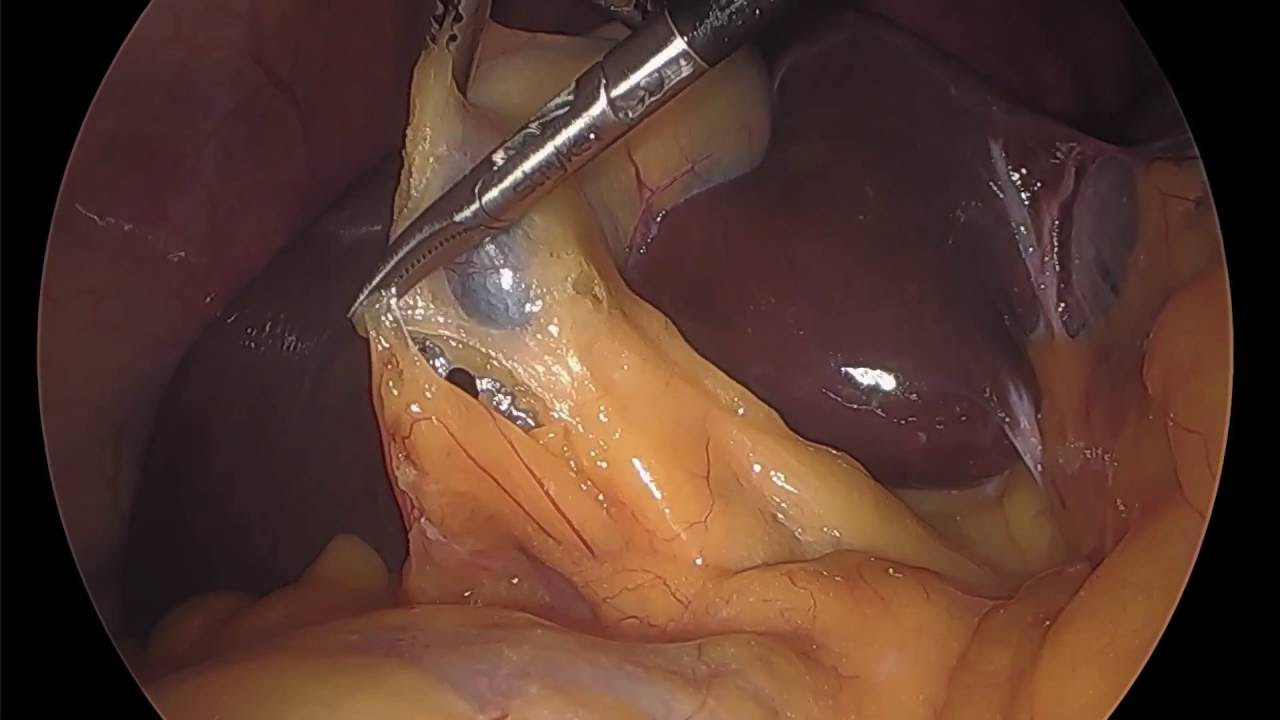 The Critical View of Safety: Enhanced Imaging w/ Use of Near Infrared Fluorescent Cholangiography