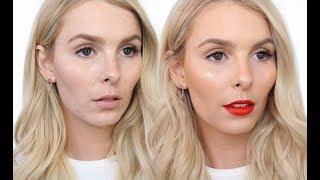 BEST TIPS FOR DEALING WITH ACNE AND BREAKOUTS | RACHAEL BROOK