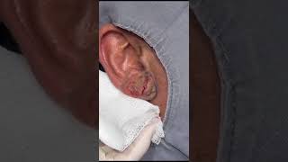Massive Ear Cyst Comes Out After Two Decades