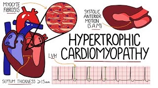 Hypertrophic Cardiomyopathy Made Easy | (Includes Hypertrophic Obstructive Cardiomyopathy & SAM)