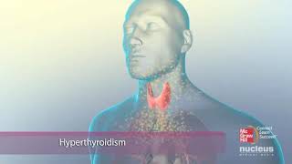 Thyroid function Hyperthyroidism 3D