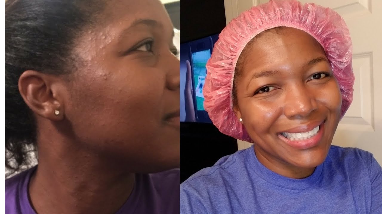 Skin Care Routine | How I Cleared Up My Acne - YouTube