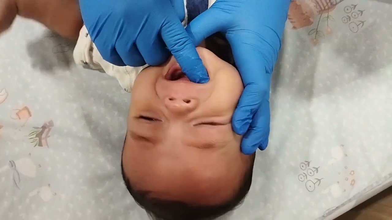 Senam Lidah setelah Insisi tongue tie