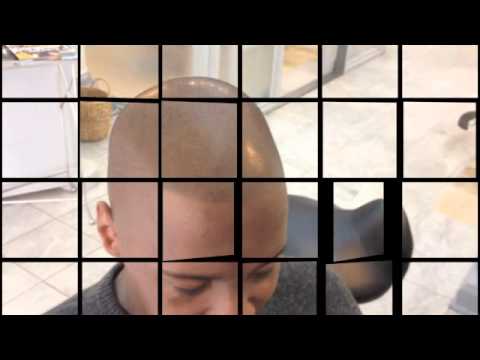 Video thumbnail: Hair Micro-Pigmentation Transplant | Men’s scallp treatment | African American Hair Loss Solution