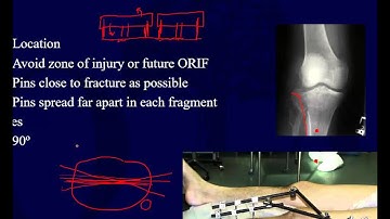 Orthopaedic Implants 2 - External Fixation