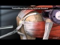 Proximal Biceps Repair using SwiveLock Tenodesis