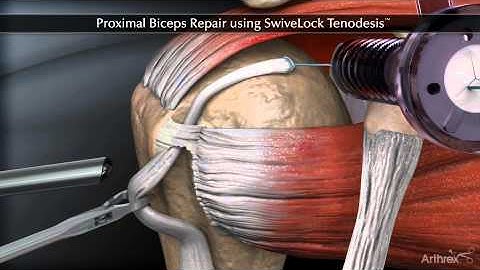 Proximal Biceps Repair using SwiveLock Tenodesis