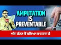Amputation Awareness | Causes, Prevention & Vascular Care Tips
