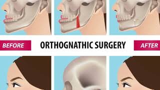 Do I need jaw or orthognathic surgery? https://www.straightsmilesolutions.com/