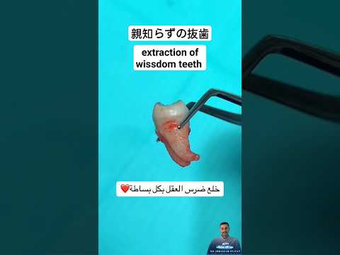 اسرع خلع ضرس عقل في العالم          