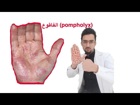  مرض الفاقوع