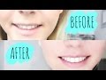 How To Get White Teeth At Home!