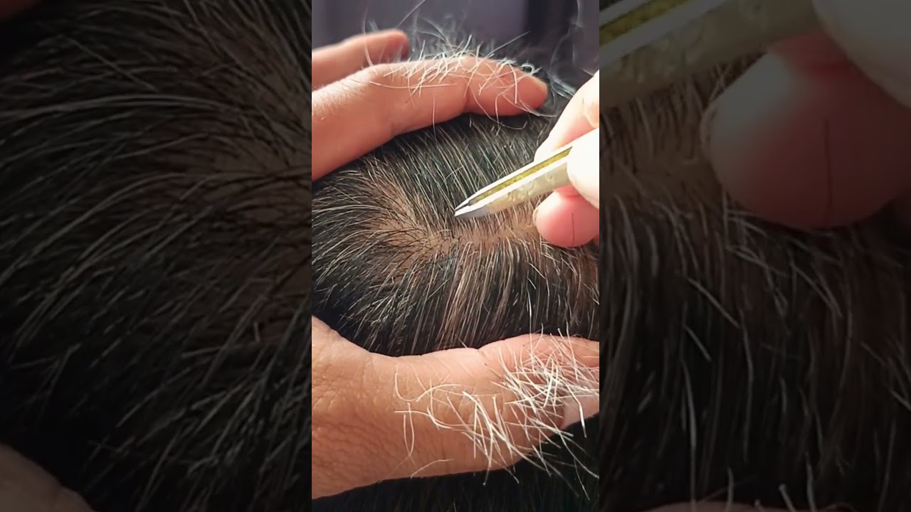 Most satisfying white hair removal 1.16#hairremoval #relaxing #satisfying
