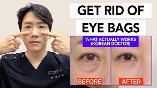 How to Get Rid of Eye Bags at Home — What Actually Works