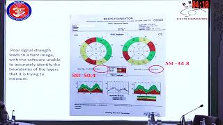 AIOC2026 IC75 Glaukom-Artefakte in OCT und Gesichtsfeld Dr. Chandrima Paul