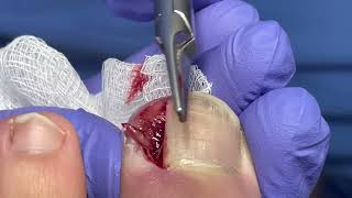 INGROWN TOENAILS REMOVAL| Paronychiaparonychie| Ingrown Toenail|Onychocryptosis