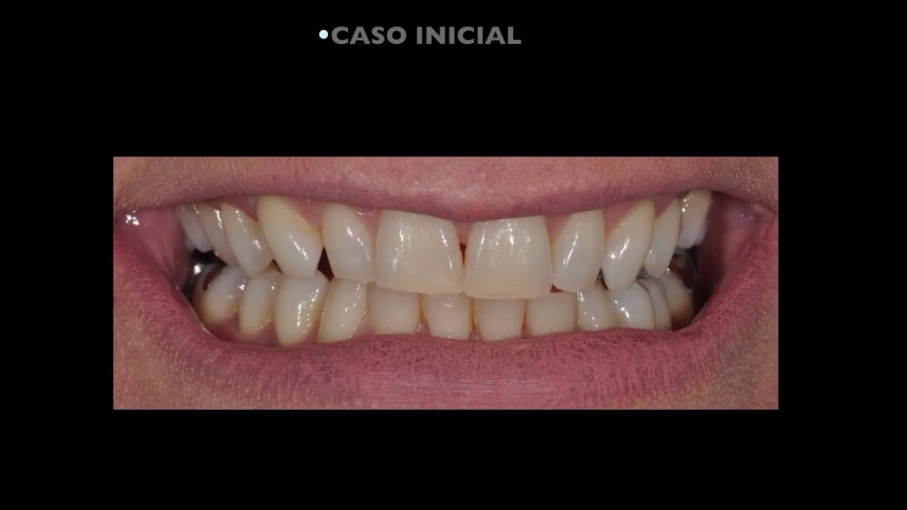 Tecnologia CAD/CAM e impressora 3D - YouTube