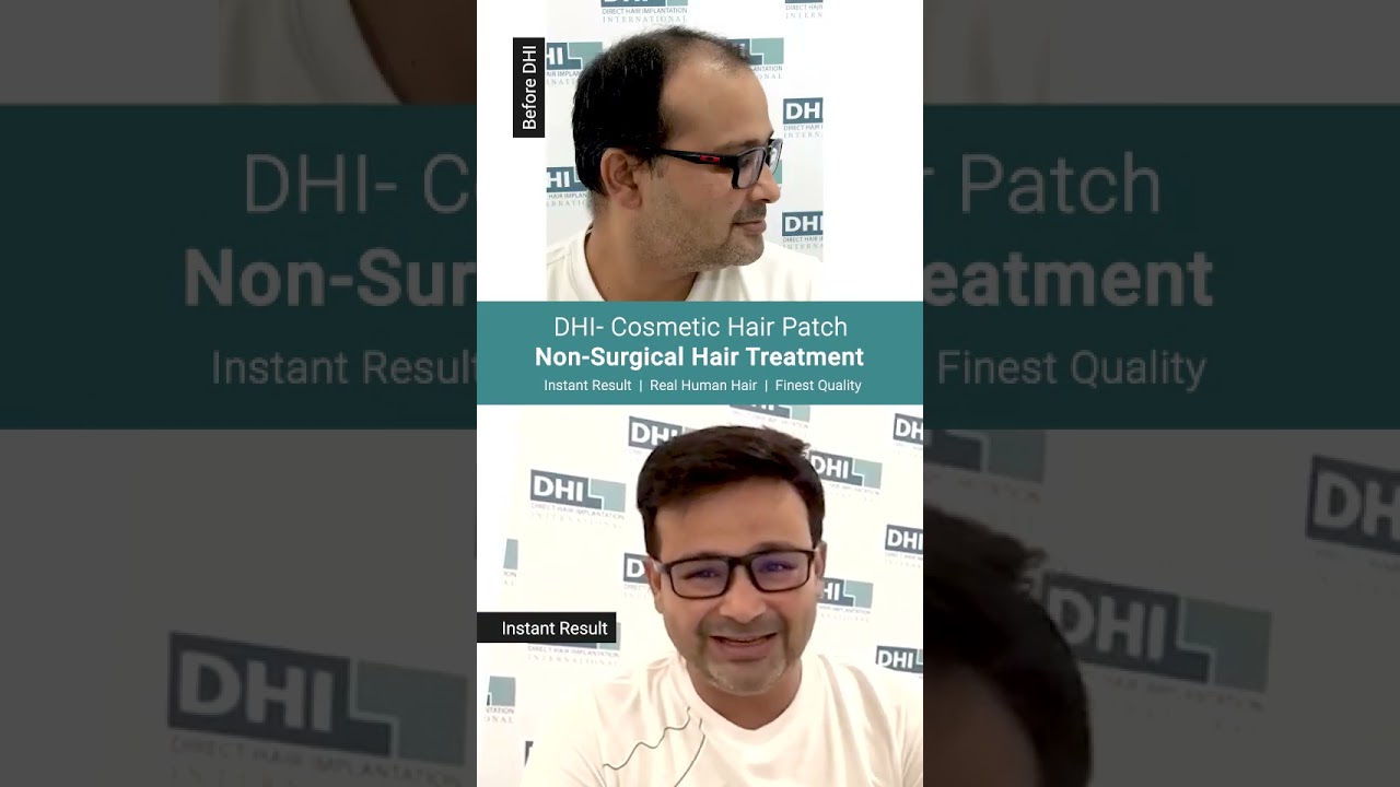 Instant Full Head of Hair | Know More About this Treatment | DHI India