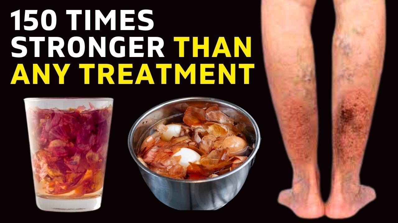 Treat Varicose Veins! Can I get rid of varicose veins forever? Yes Get