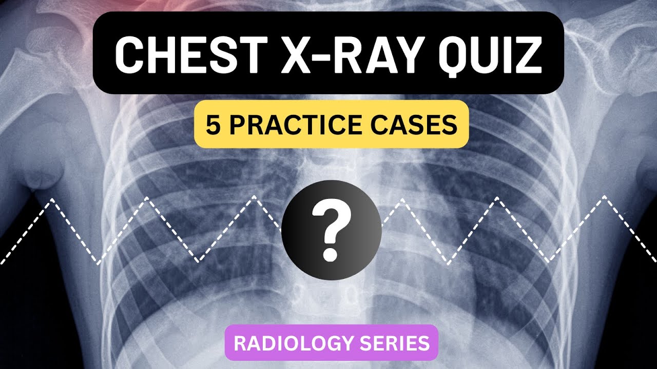 Chest X-ray Quiz | 5 Practice CXR Cases with Explanations