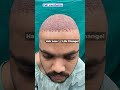 Bald Days are Officially Over 😎 #trending #reels #shorts #hairtransformation #haircare #hair #best