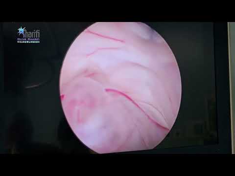 عمل با تکنیک دو سوراخه        