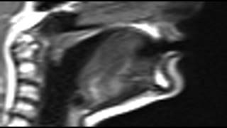Ultrax MRI vd alveolar approximant