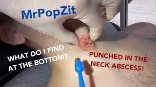 I Punch A Deep Hole To The Core Of This Abscess You Can See What Caused It See It Clearly Amazing