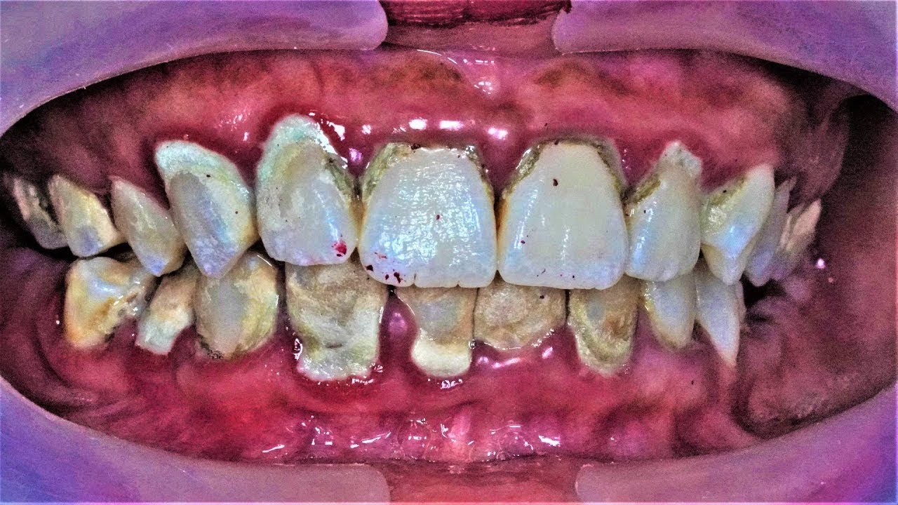Deep Cleaning With HEAVY Tartar Build Up At The Dentist YouTube