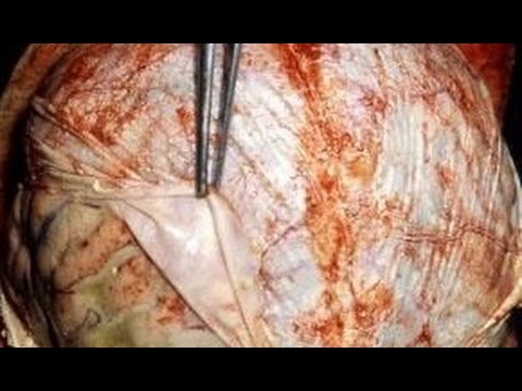 СЕРОЗНЫЕ МЕНИНГИТЫ. НЕВРОЛОГИЯ