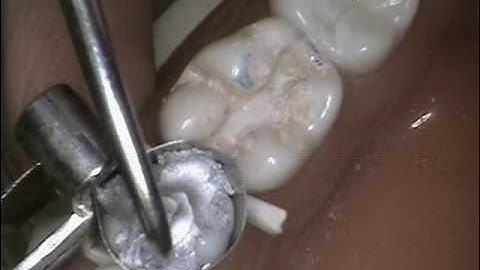 Class II amalgam with audio