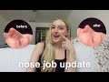 1 year nose job update | healing journey (including progress pictures) &amp; answering your common q&#39;s!