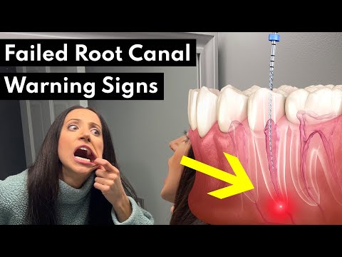 7 Warning Signs Your Root Canal FAILED