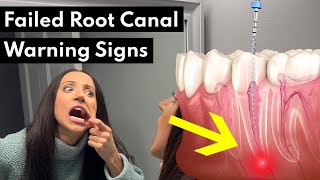 7 Warning Signs Your Root Canal FAILED screenshot 5