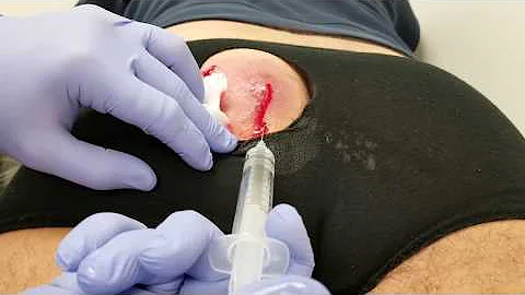 Co je cysta v vaječníku?