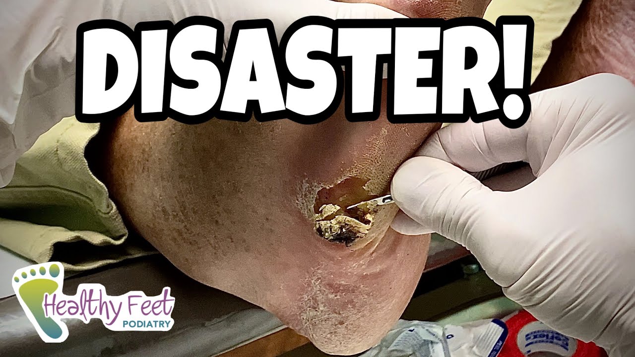 DIABETIC FOOT CATASTROPHE!  IS THERE PUS OR A DIABETIC ULCER UNDER THE ENORMOUS FOOT CALLUSES?