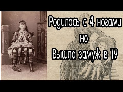 Девушка которая родилась с 4 ногами