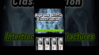 Boyd and Griffin classification of intertrochanteric fractures #TrochanteFracture #traumasurgery