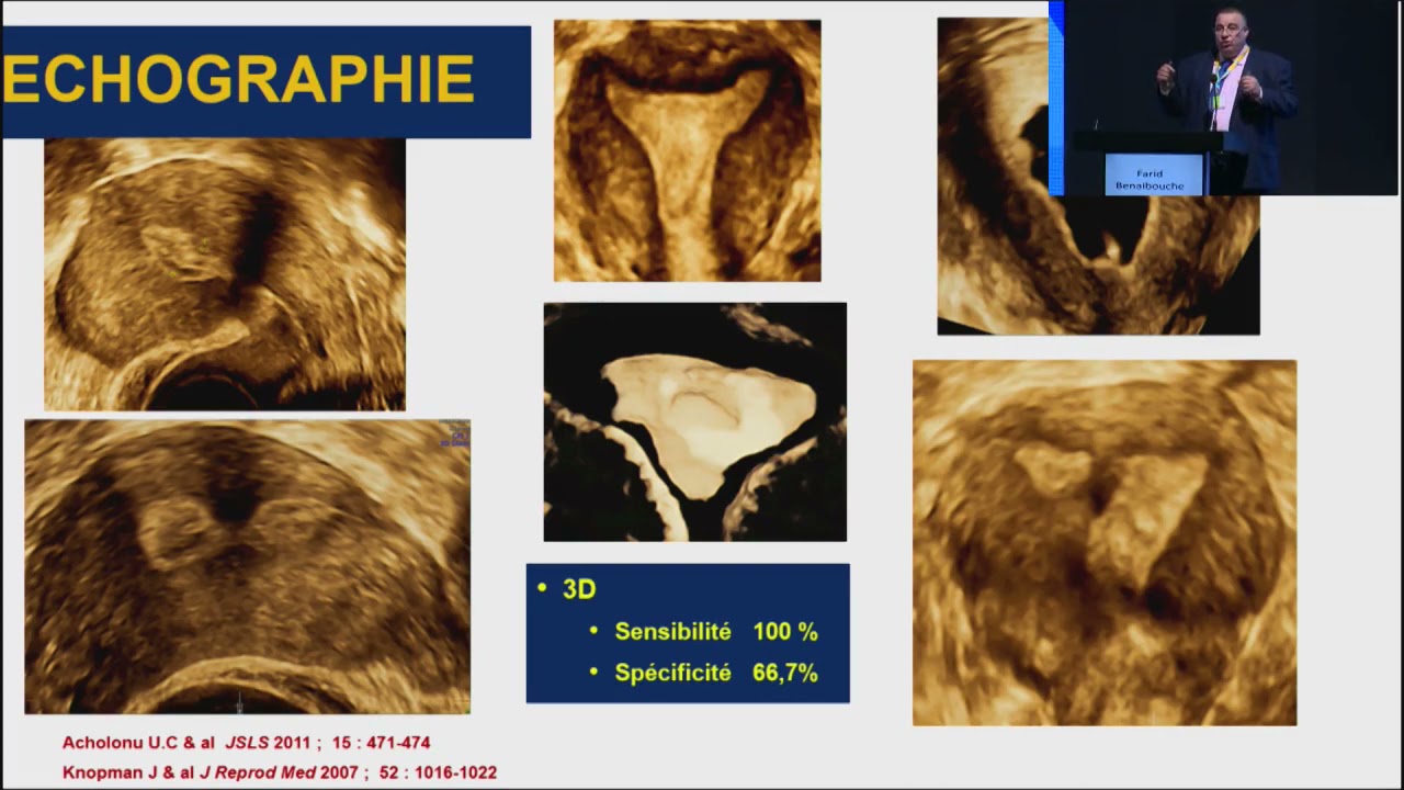 28 ème Congrès de la STGO: Farid benaibouch: La Cure de Synéchie