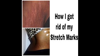 HOW I GOT RID OF MY STRETCH MARKS IN NO TIME