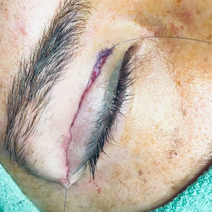 Zip Stitch Upper Blepharoplasty