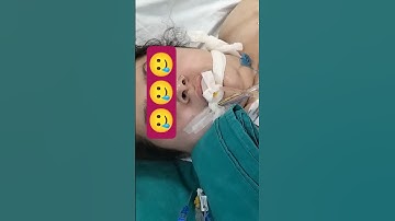 GCS score - Eye response score #drmanoj #viral #youtube #icu #hospital #video #gcs #shorts #beats