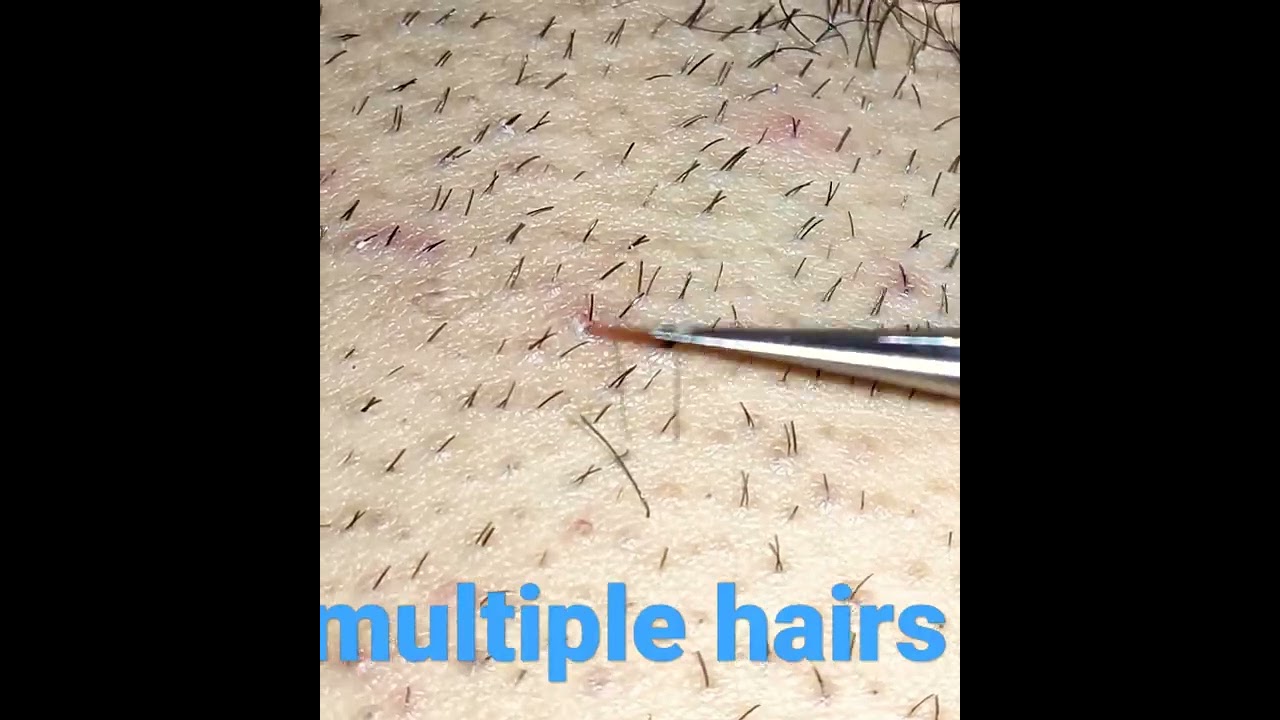 105 thick hair plucking multiple hairs in one follicle#shorts - YouTube