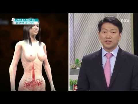 [HIT] 무엇이든 물어보세요 - 골다공증, 이런 사람 주의하라! 20151103