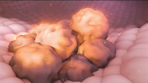 Cancer Treatment: IMRT (Radiation Therapy)