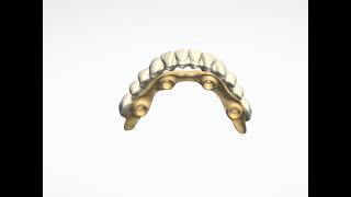 Implant Bar with Overdenture