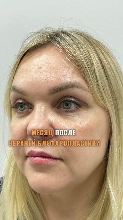 #блефаропластика #нависшиевеки #beforeandafter #пластикавек #казань # ...